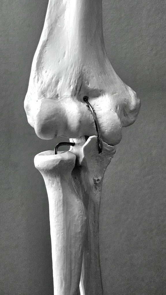 Knee Replacement